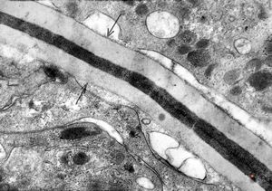 M,43y. | blood - degraded Candida (bone marrow suppression)